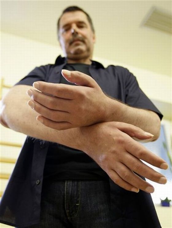 Первые в мире искусственные руки (13 фото)